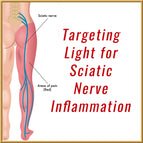 Sciatic Nerve Pain & Inflammation - Recorded